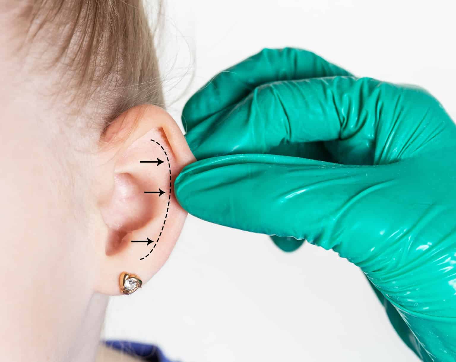 otoplastie risques