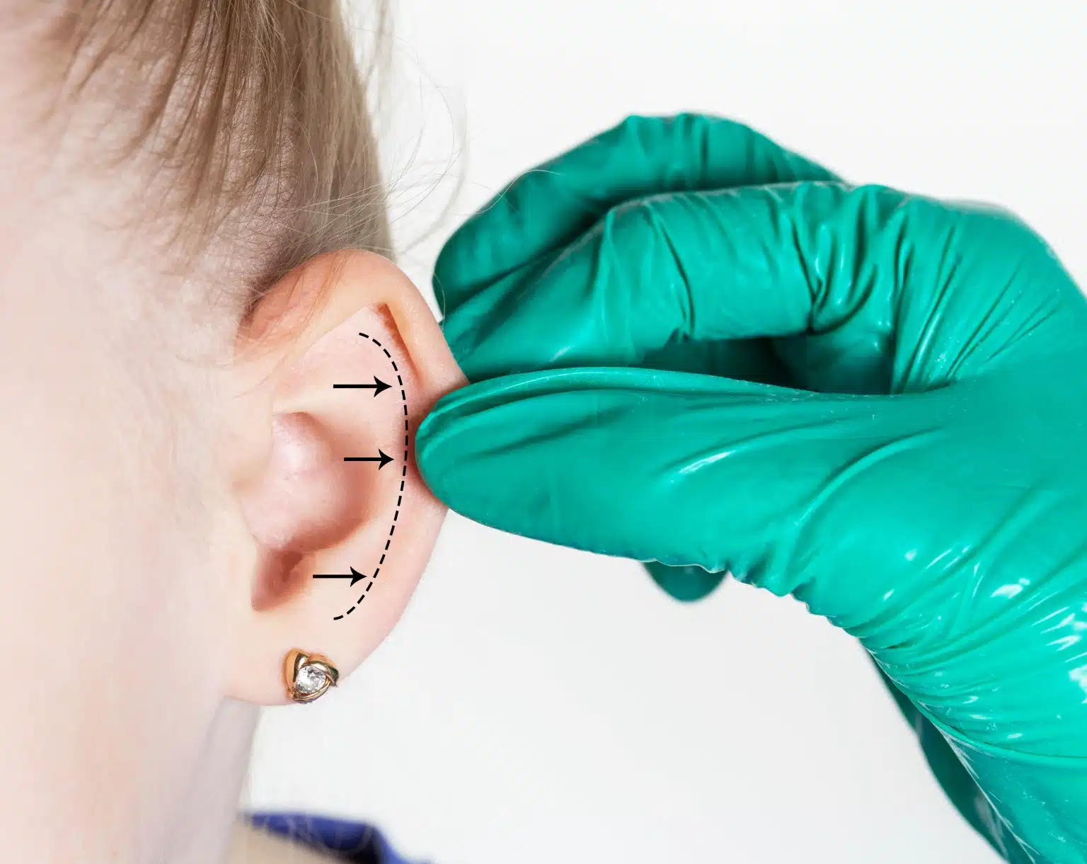 Quels sont les risques et complications possibles après une otoplastie ?