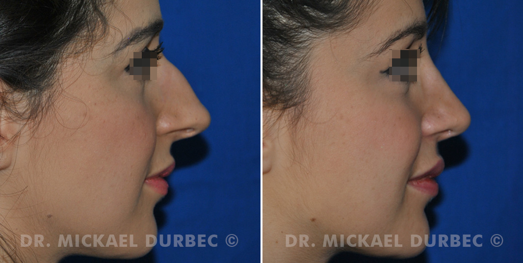 Rhinoplastie, correction du bosse cartilagineuse, photo avant et après à Lyon | Dr Durbec