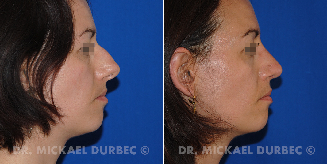 Rhinoplastie, correction du bosse cartilagineuse, photo avant et après 4 à Lyon | Dr Durbec