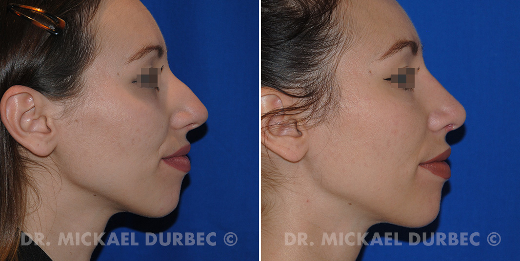 Rhinoplastie, correction du bosse cartilagineuse, photo avant et après 2 à Lyon | Dr Durbec