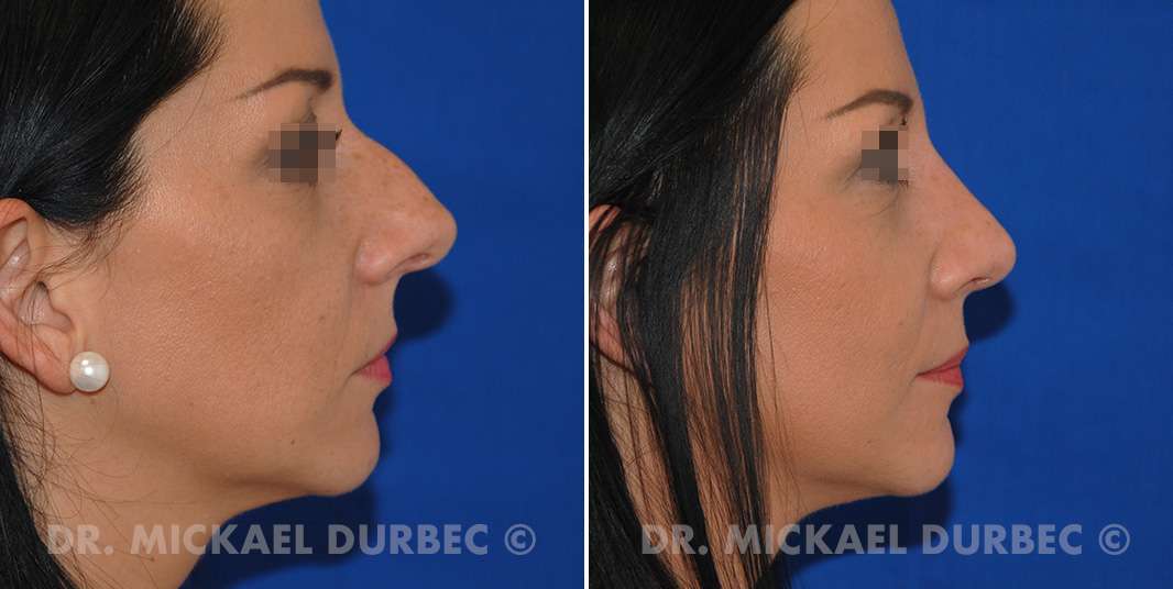 Rhinoplastie, correction du bosse cartilagineuse, photo avant et après 3 à Lyon | Dr Durbec
