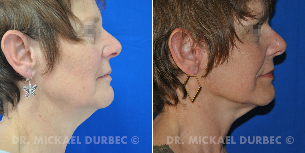 Lifting cervico-facial, photo avant et aprés à Lyon | Dr Durbec
