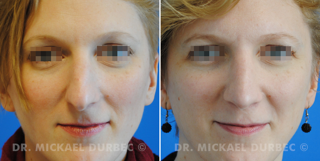 Rhinoplastie, correction du bosse cartilagineuse, photo avant et après 6 à Lyon | Dr Durbec