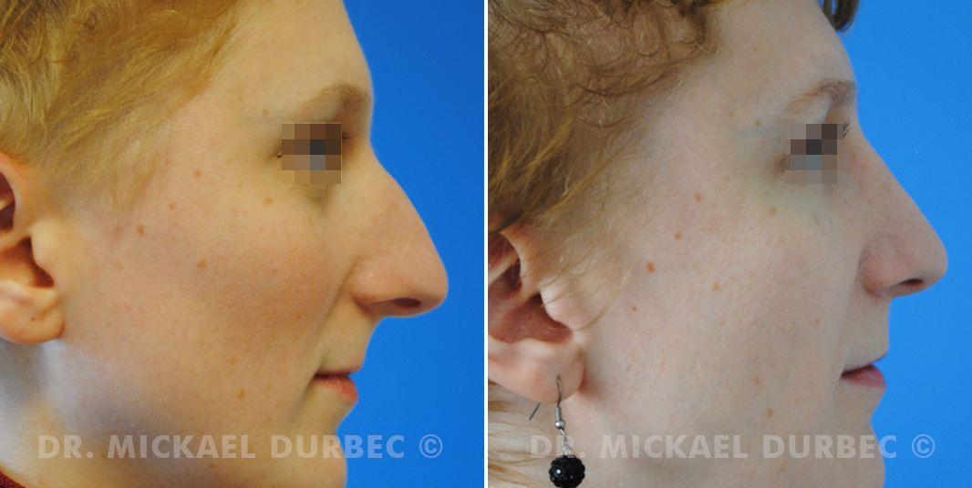 Correction du bosse osteocartilagineuse, pointe-tombante, photo avant et après à Lyon | Dr Durbec