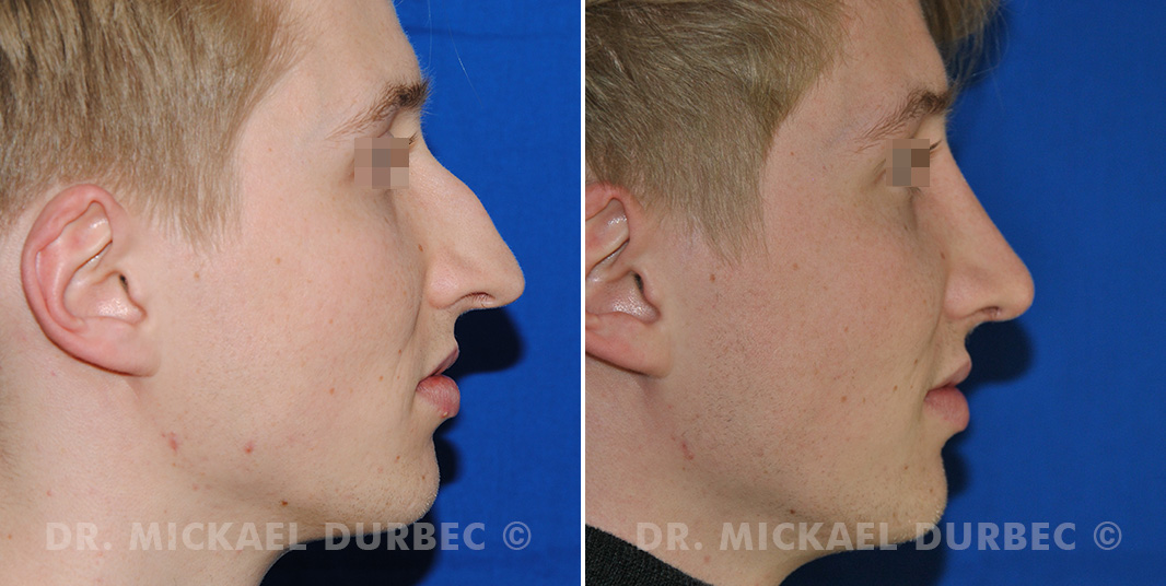 Rhinoplastie, correction du bosse cartilagineuse, photo avant et après 7 à Lyon | Dr Durbec