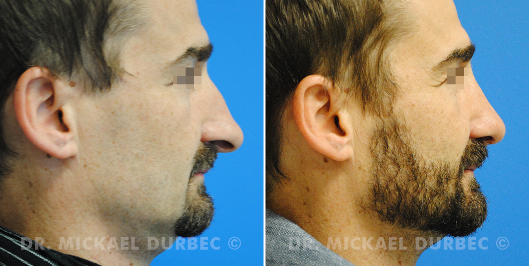 Rhinoplastie, correction du nez long et pointe tombante, photo avant et après à Lyon | Dr Durbec